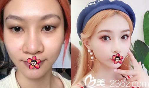 寧波時(shí)光美極張震眼鼻綜合案例 寧波時(shí)光美極張震眼鼻綜合案例