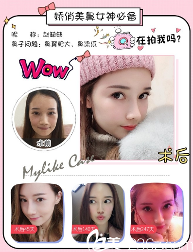 廣州美萊羅延平隆鼻案例