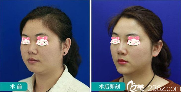 在愛思特隆鼻+玻尿酸豐下巴效果圖