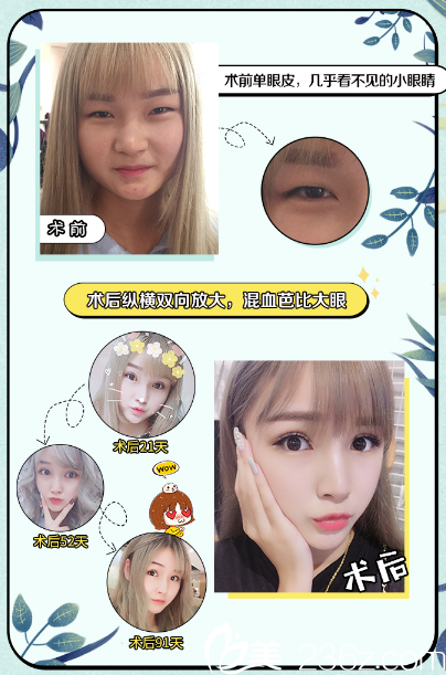 廣州美萊陳貴宗雙眼皮案例