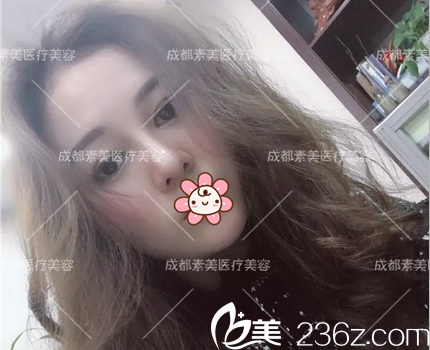 在找楊迪做的帕克雙眼皮效果很好，我又找他做了膨體隆鼻