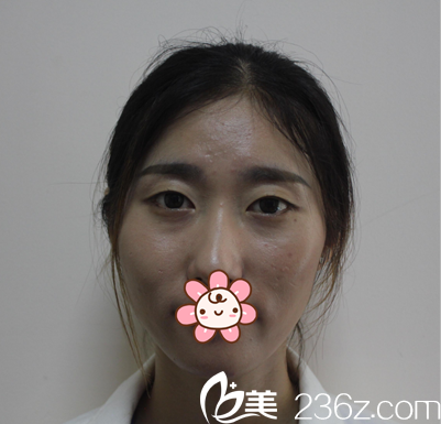 雙眼皮手術(shù)前素顏照片 雙眼皮手術(shù)前素顏照片