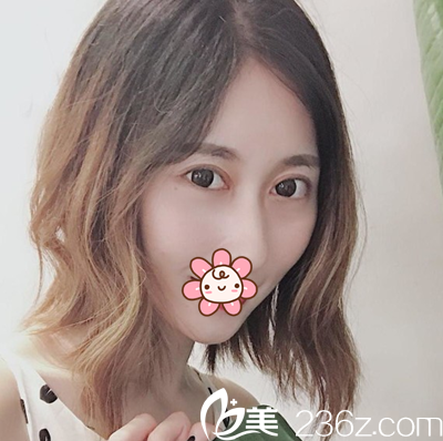 車紅昌切開雙眼皮術(shù)后一個(gè)月 車紅昌切開雙眼皮術(shù)后一個(gè)月