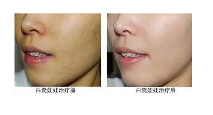 衡陽摩姿白瓷娃娃嫩膚美白真人案例