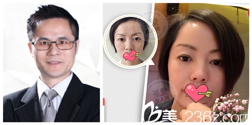 曾海波院長線雕前后真人對比 曾海波院長線雕前后真人對比