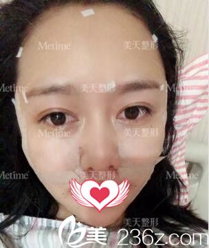 術后天效果 術后天效果