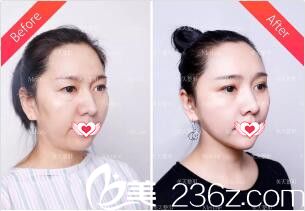 術后2周時與術前對比效果 術后2周時與術前對比效果