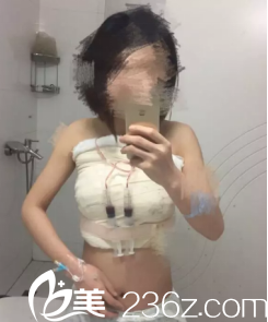 青島華韓做假體隆胸手術挺好的，分享青島華韓真人隆胸日記給你參考