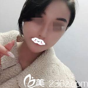 終于預(yù)約到了蔣松林院長做了精雕仿生隆鼻，給你們看下我術(shù)后半個(gè)月的效果吧