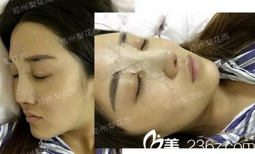 顧客周周在鄭州梨花雨做隆鼻修復(fù)術(shù)后 顧客周周在鄭州梨花雨做隆鼻修復(fù)術(shù)后