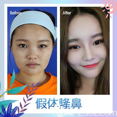 廣州廣美徐立志隆鼻案例