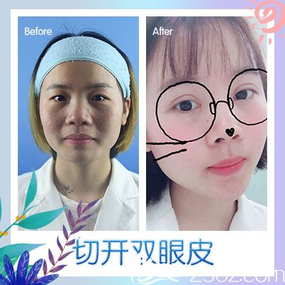 廣州廣美徐立志雙眼皮案例圖片