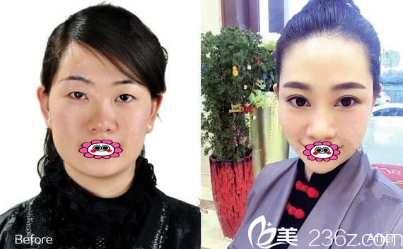 醫(yī)療美容李超院長雙眼皮前后變化圖