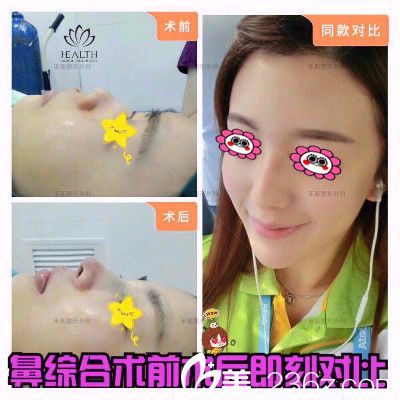 的彭煒峰為我做的鼻綜合<span style=