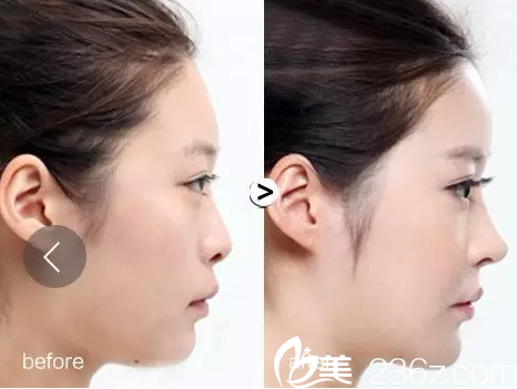 哈爾濱臻美玻尿酸隆鼻真人案例