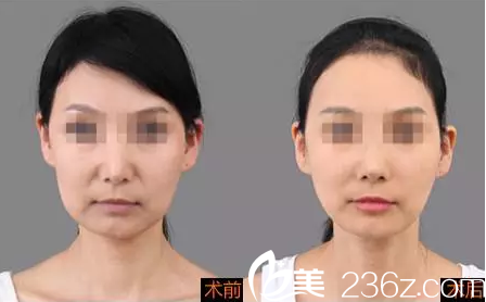 哈爾濱臻美注射法令紋前后效果