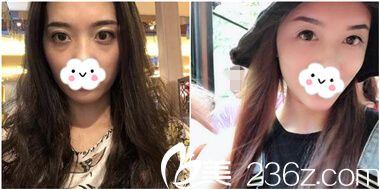 胡俊杰主任全面部自體脂肪填充案例