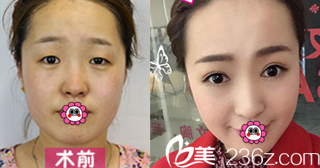 北京惠合嘉美切開(kāi)雙眼皮案例