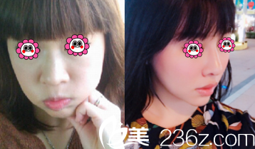 北京惠合嘉美胡俊峰耳軟骨復(fù)合隆鼻案例