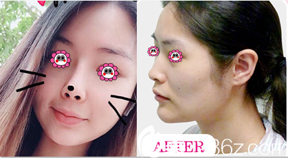 北京惠合嘉美醫(yī)院隆鼻多少錢(qián)？達(dá)拉斯定制鼻綜合15800元起