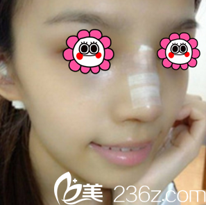 胡俊峰醫(yī)生給我做鼻綜合第4天樣子