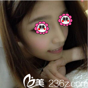 在北京惠合嘉美做膨體+耳軟骨綜合隆鼻第23天效果