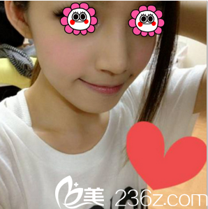 北京惠合嘉美膨體+耳軟骨鼻綜合案例