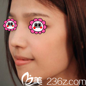 我看了北京惠合嘉美胡俊峰隆鼻案例后就做了膨體耳軟骨鼻綜合