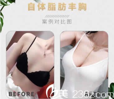 運(yùn)城臻美整形醫(yī)院正規(guī)嗎？透露2019優(yōu)惠價(jià)格表及自體脂肪隆胸顧客評(píng)價(jià)