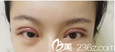 李明鐘給我做雙眼皮3天了 李明鐘給我做雙眼皮3天了