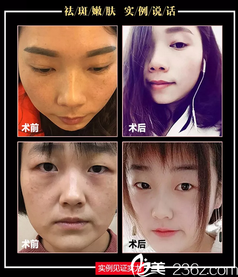 淮北美萊塢皮秒激光祛斑前后案例效果對比