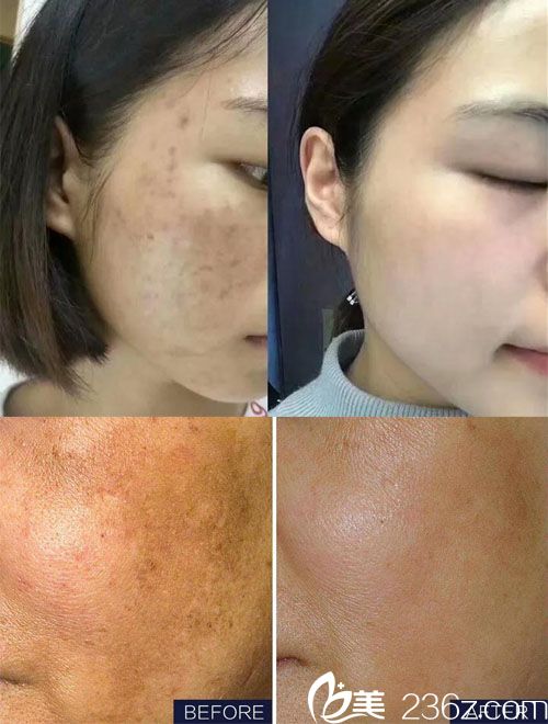 淮北美萊塢蜂巢皮秒激光祛斑案例前后對比圖