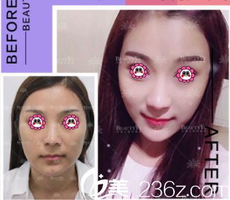 北京葉美人面部埋線提升優(yōu)惠價(jià)格表公布！全面部PPDO生物蛋白線12800元起