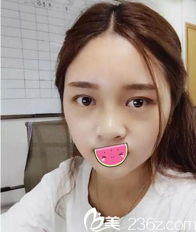 22歲的小琴在瀘州花都找謝英做了雙眼皮鼻綜合手術(shù)，術(shù)后3個(gè)月效果宛若天成