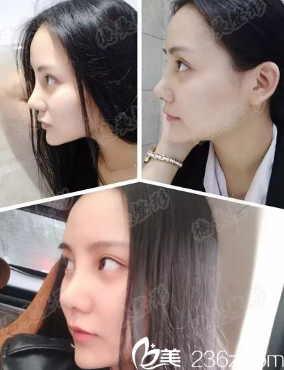 婁底德美鼻綜合真人案例