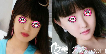 北京瑞妍茗醫(yī)面部吸脂多少錢(qián)？面部單部位吸脂2499元起附案例