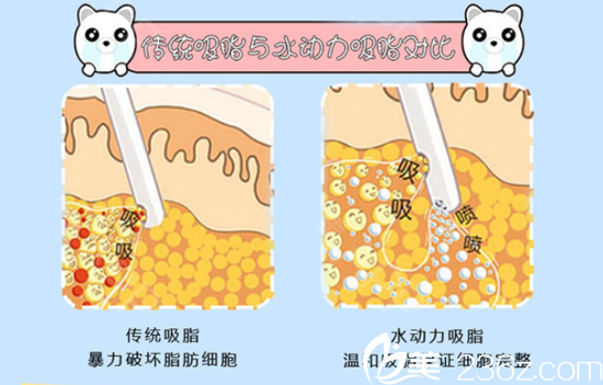 贛州亞韓整形醫(yī)院360°水動力吸脂