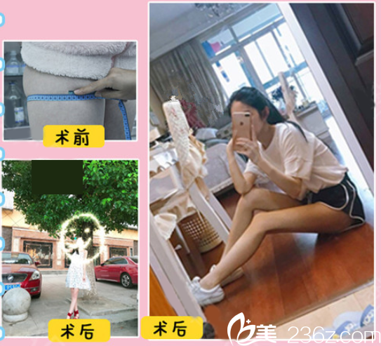 贛州亞韓360°水動力吸脂手術，德國進口水動力吸脂儀器，術后安全不反彈，助你成功瘦身