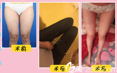 贛州亞韓整形醫(yī)院吸脂手術案例