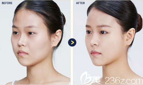 韓國ST醫(yī)院眼綜合+脂肪填充 +下頜瘦臉除皺對比圖 韓國ST醫(yī)院眼綜合+脂肪填充 +下頜瘦臉除皺對比圖
