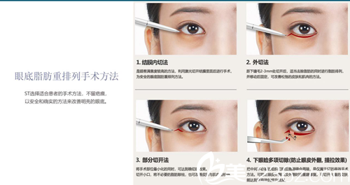 韓國ST醫(yī)院眼底脂肪重排列手術(shù)方法 韓國ST醫(yī)院眼底脂肪重排列手術(shù)方法