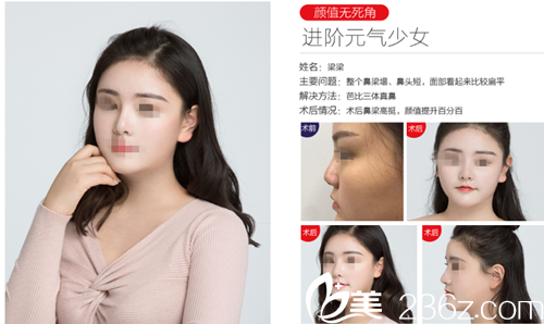 贛州德爾美客韓式生科假體隆鼻，小翹鼻盡顯風情，優(yōu)惠低至4580，院長親自操刀