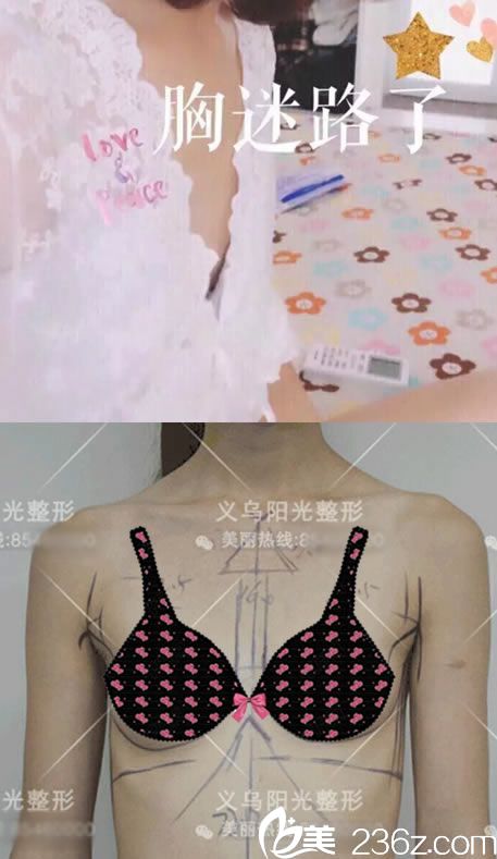 在義烏陽光醫(yī)院做隆胸前 在義烏陽光醫(yī)院做隆胸前