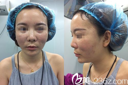 做埋線提升前面部情況 做埋線提升前面部情況