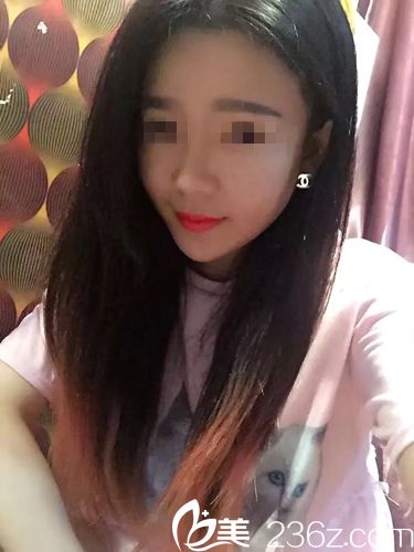 埋線提升術(shù)后一周效果 埋線提升術(shù)后一周效果