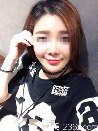 面部埋線提升術(shù)后一個(gè)多月效果 面部埋線提升術(shù)后一個(gè)多月效果