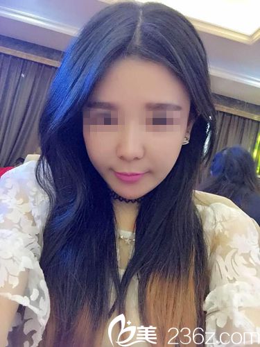 術(shù)前面部松弛+雙下巴的美女找武漢樂美汪文娟院長做了埋線提升后法令紋也都消失了