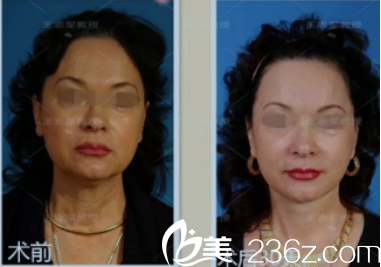 術(shù)后對比圖