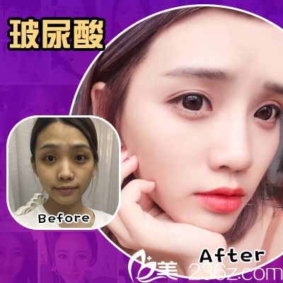 廣州美萊海薇玻尿酸面部填充案例