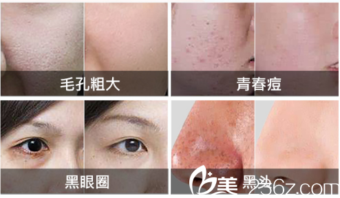 廣州美萊彩光嫩膚案例